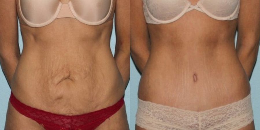 Tummy Tuck - Case 19220