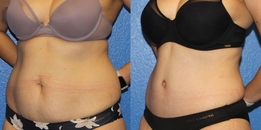 Tummy Tuck - Thumbnail 2