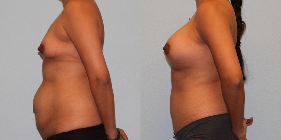 Tummy Tuck - Thumbnail 3