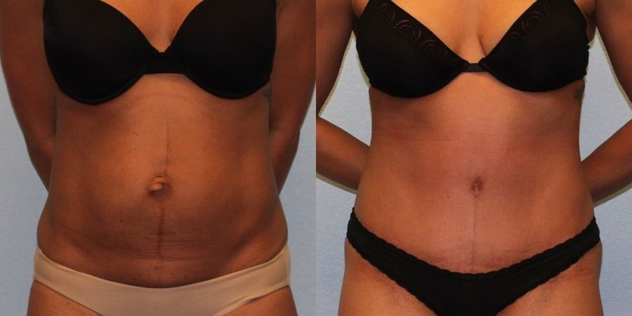 Tummy Tuck - Case 19198