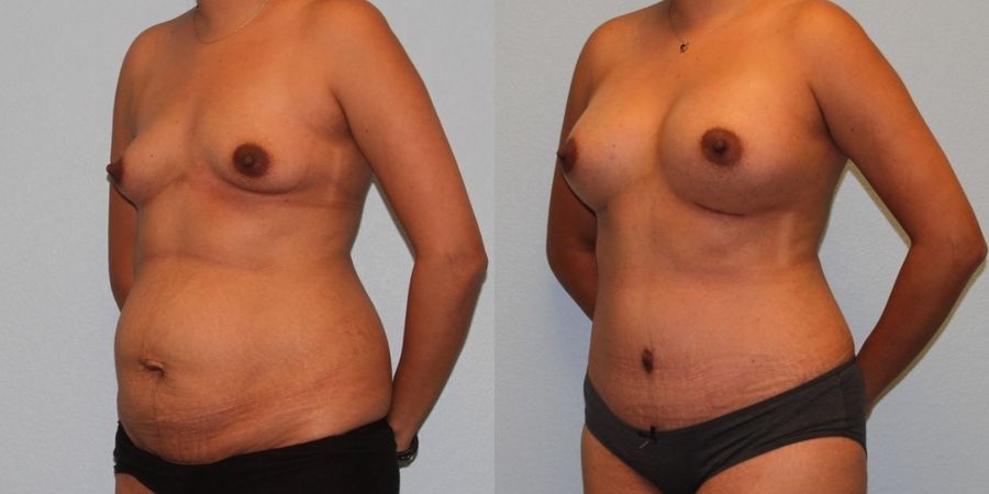 Tummy Tuck - Thumbnail 2