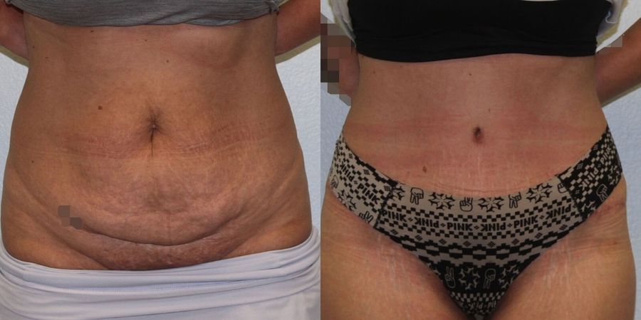 Tummy Tuck - Case 19226