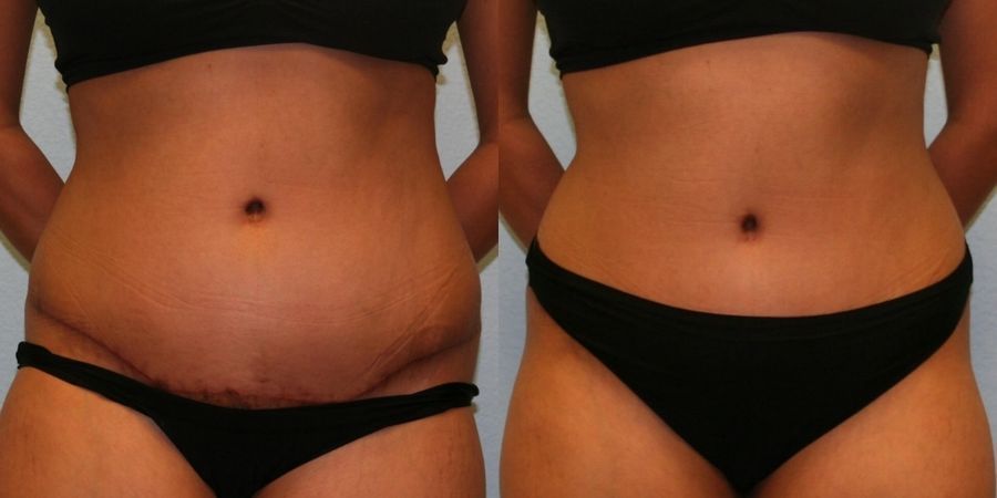 Tummy Tuck - Thumbnail 4