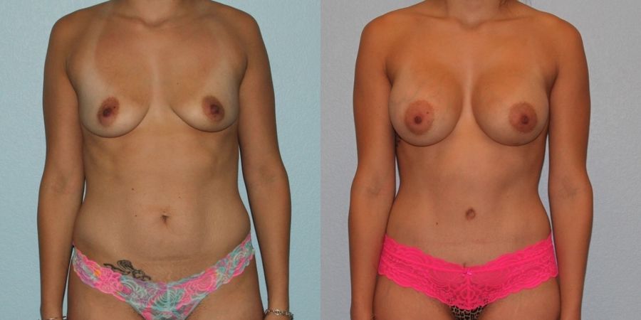 Tummy Tuck - Case 19216