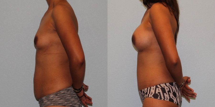 Tummy Tuck - Thumbnail 3