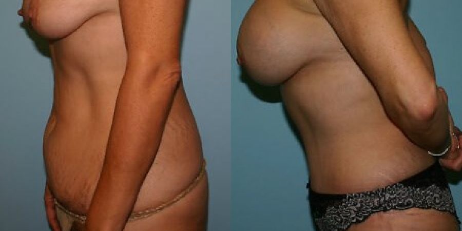 Tummy Tuck - Thumbnail 3