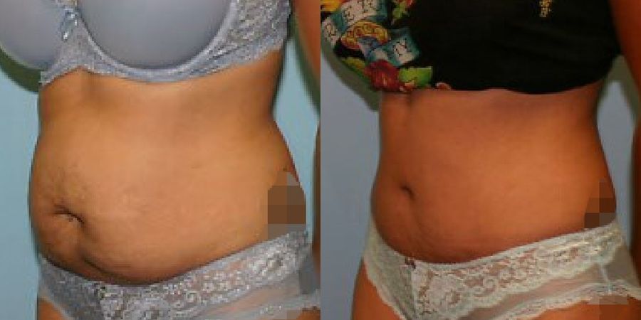 Tummy Tuck - Thumbnail 2