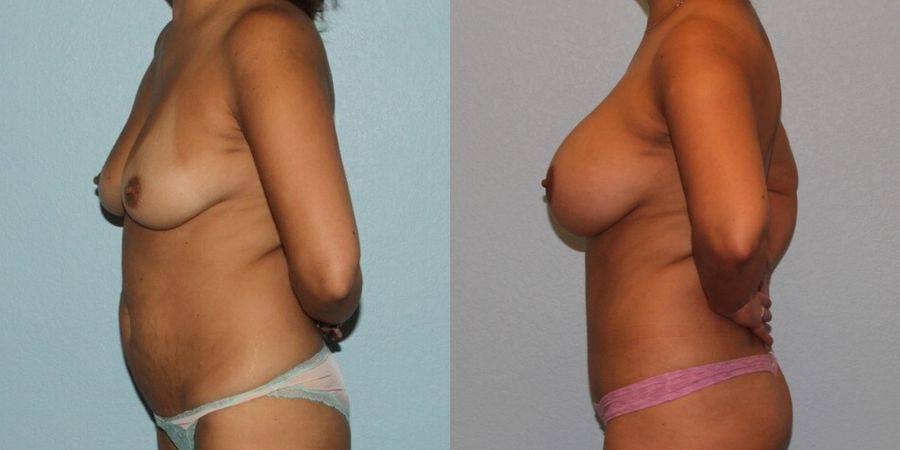 Tummy Tuck - Thumbnail 3