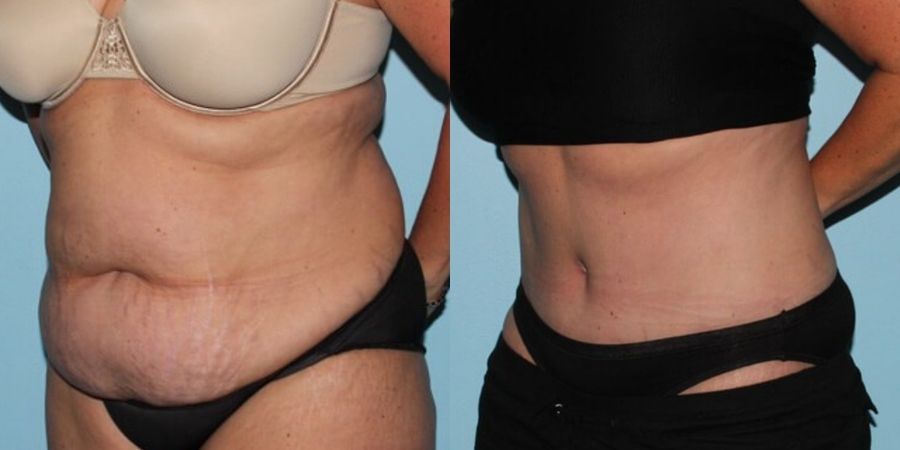 Tummy Tuck - Thumbnail 2