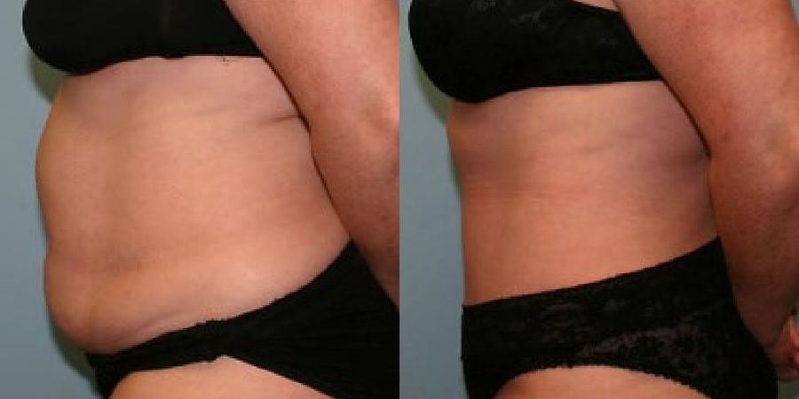 Tummy Tuck - Thumbnail 3