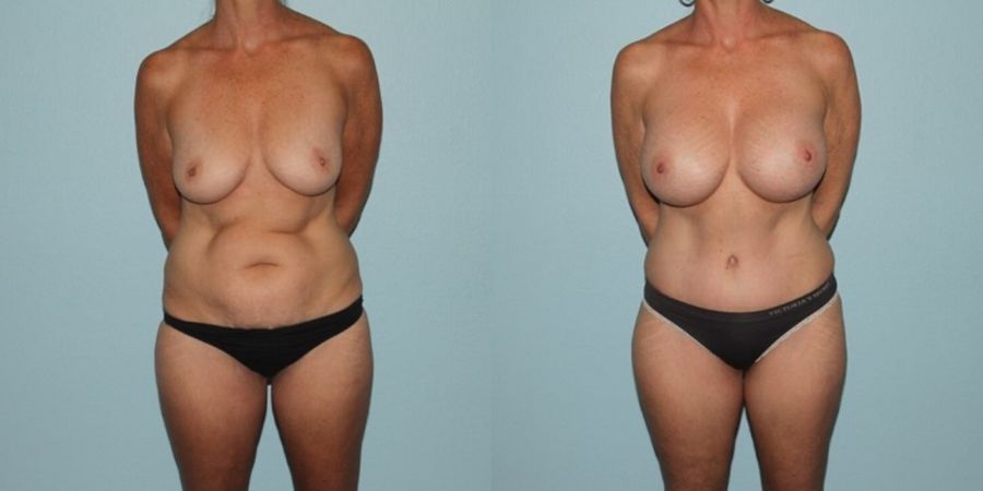 Tummy Tuck - Case 19239