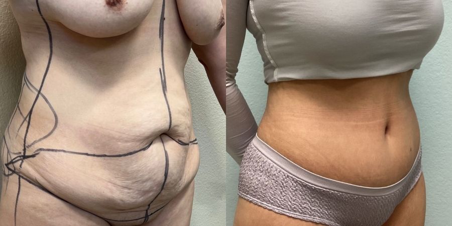 Tummy Tuck - Thumbnail 2