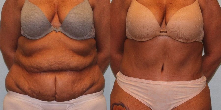 Tummy Tuck - Case 19222