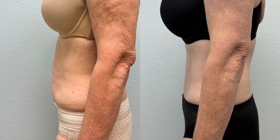 Tummy Tuck - Thumbnail 3