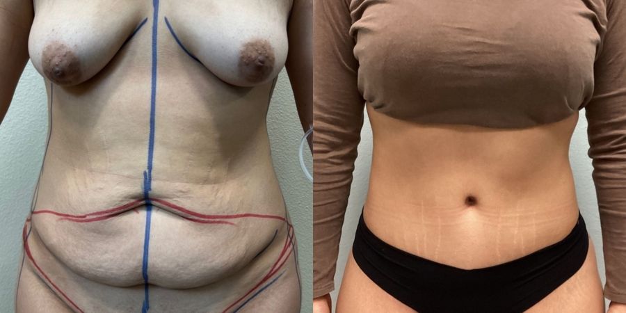 Tummy Tuck - Case 19247