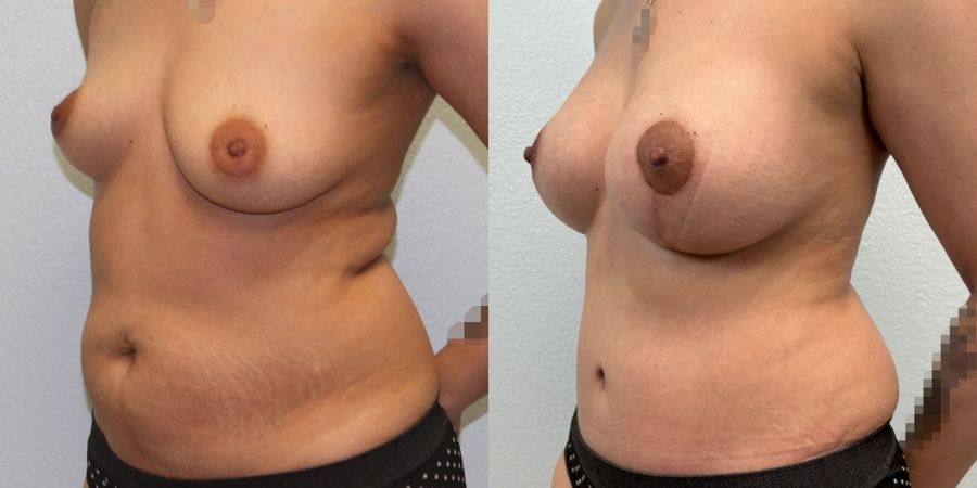 Tummy Tuck - Thumbnail 2