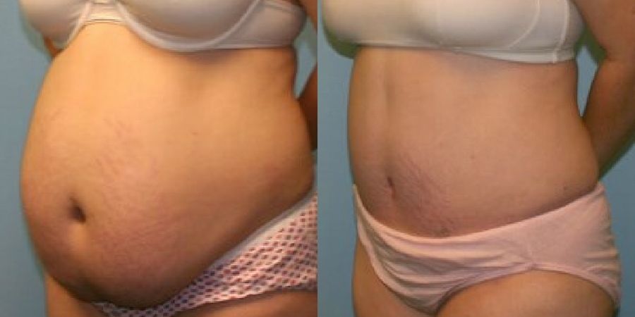 Tummy Tuck - Thumbnail 2