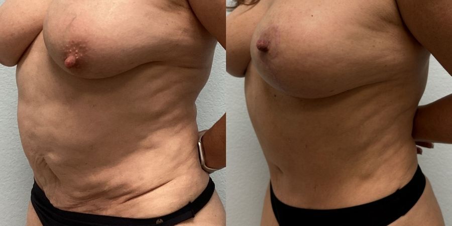 Tummy Tuck - Thumbnail 2