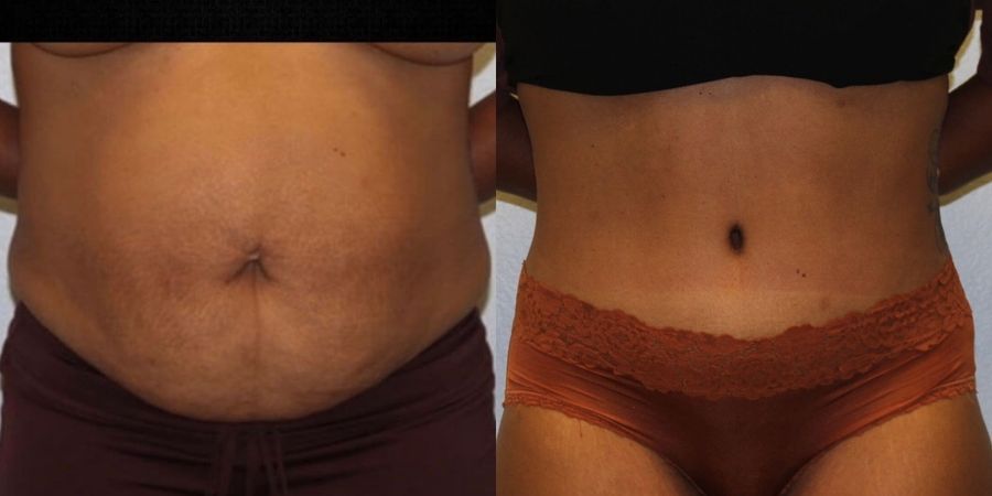 Tummy Tuck - Case 19233