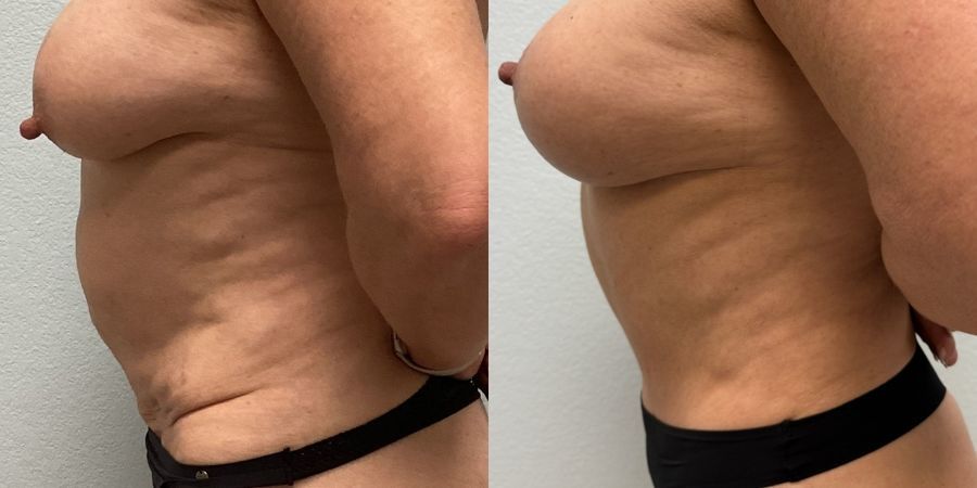 Tummy Tuck - Thumbnail 3