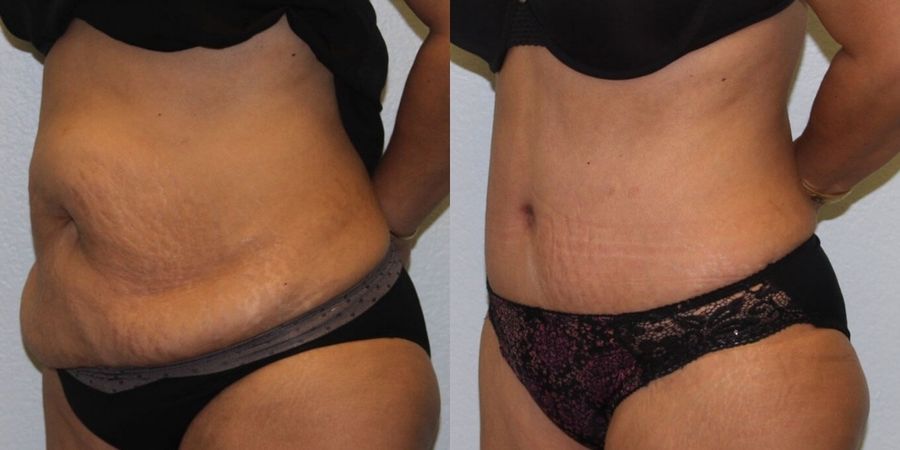 Tummy Tuck - Thumbnail 2