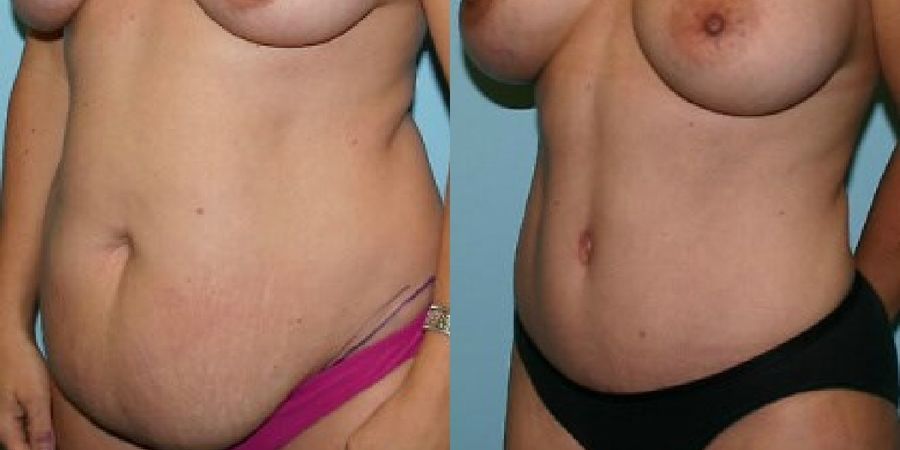 Tummy Tuck - Thumbnail 2