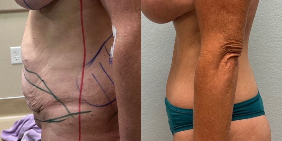 Tummy Tuck - Thumbnail 3