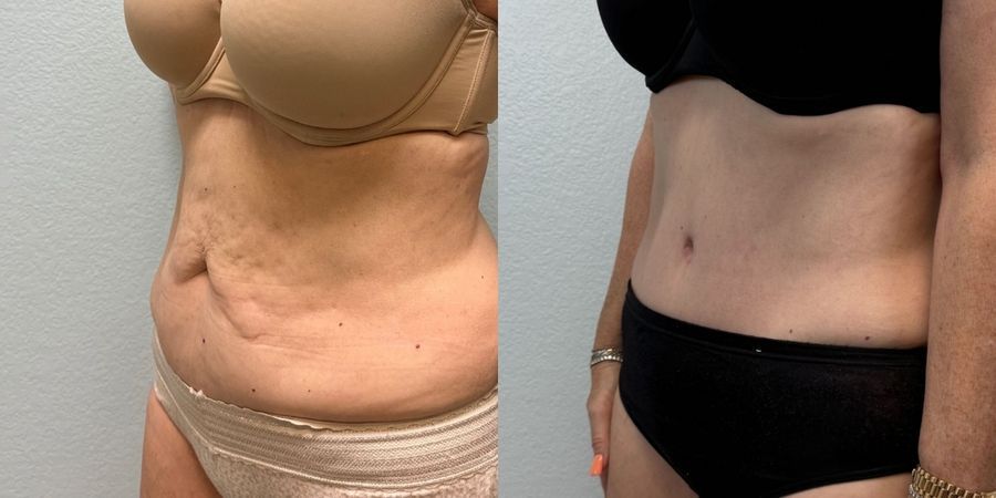 Tummy Tuck - Thumbnail 2