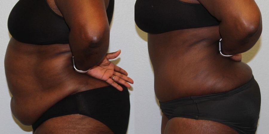 Tummy Tuck - Thumbnail 3