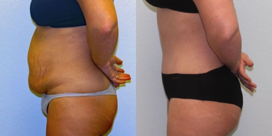 Tummy Tuck - Thumbnail 3