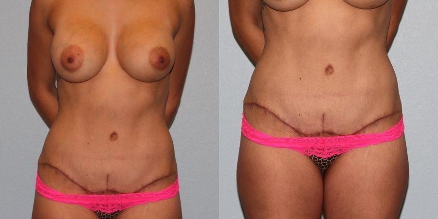 Tummy Tuck - Thumbnail 4