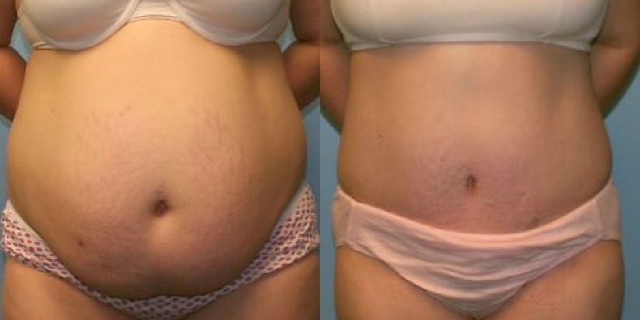 Tummy Tuck - Case 19210