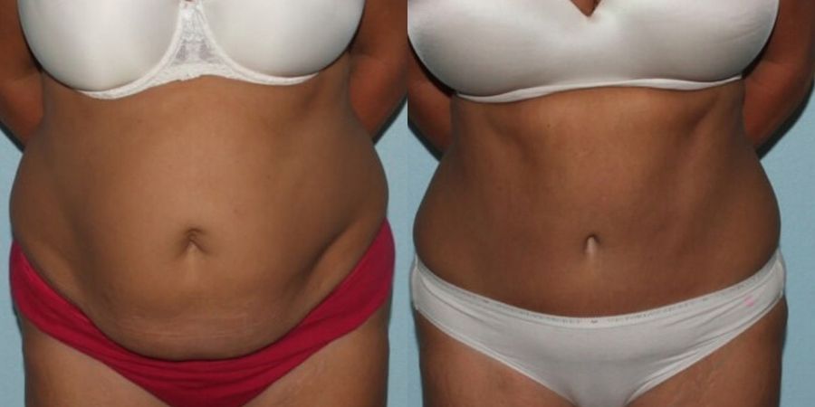 Tummy Tuck - Case 19221