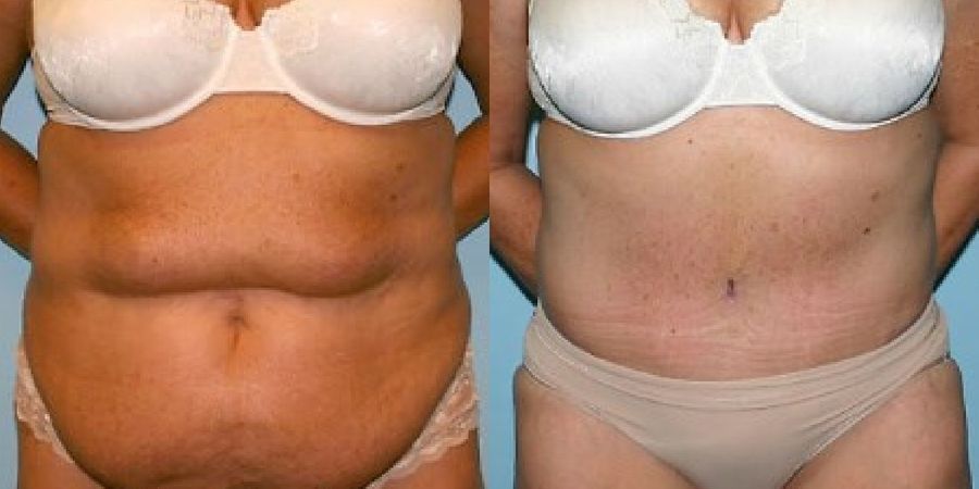 Tummy Tuck - Case 19209
