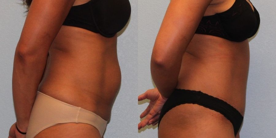 Tummy Tuck - Thumbnail 3