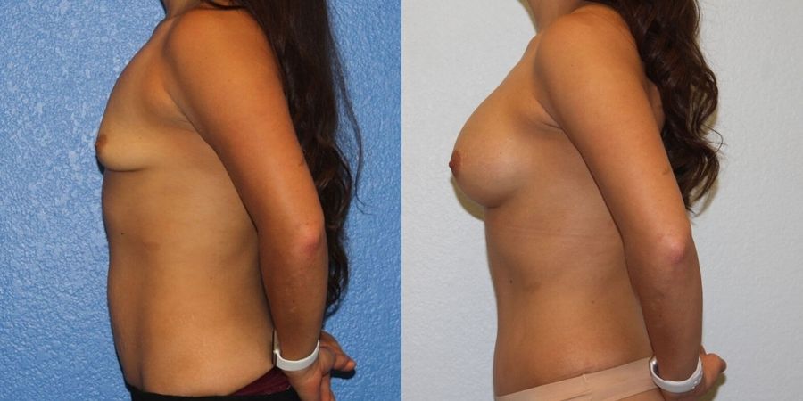 Tummy Tuck - Thumbnail 3