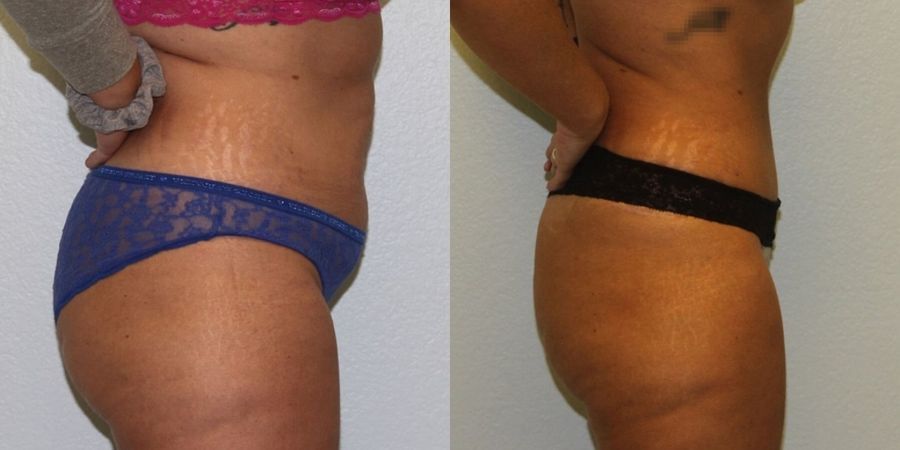 Tummy Tuck - Thumbnail 2