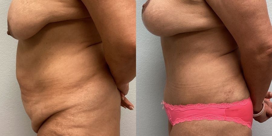 Tummy Tuck - Thumbnail 3