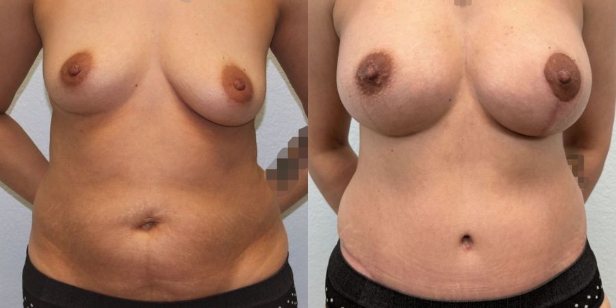 Tummy Tuck - Case 19242