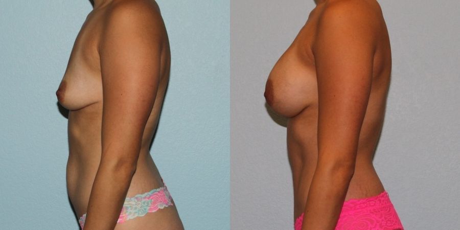 Tummy Tuck - Thumbnail 3