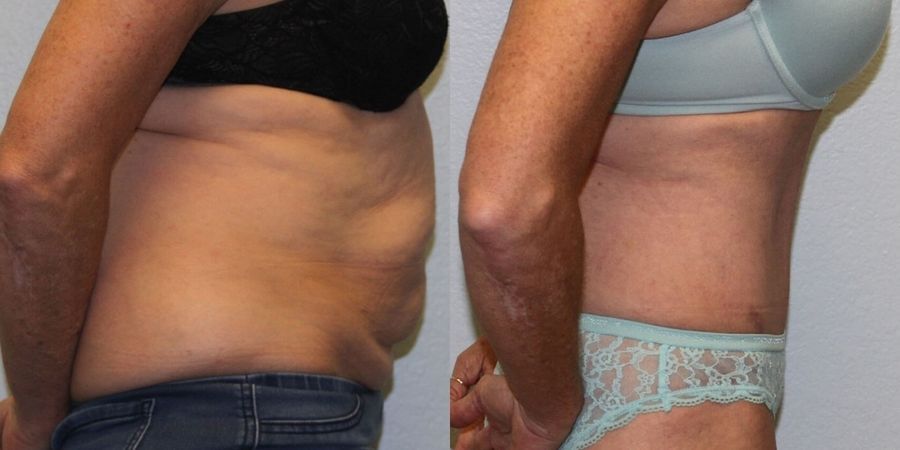 Tummy Tuck - Thumbnail 3