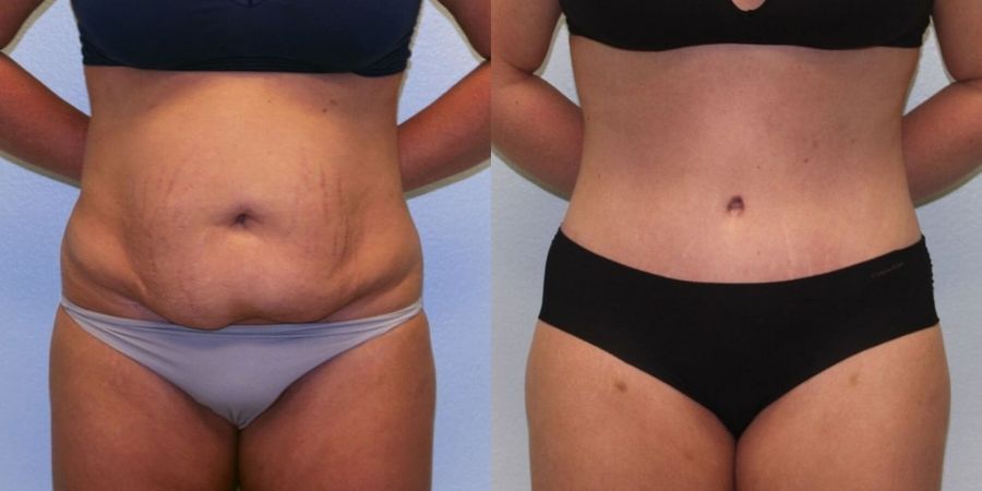 Tummy Tuck - Case 19241