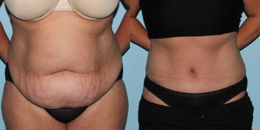 Tummy Tuck - Case 19218