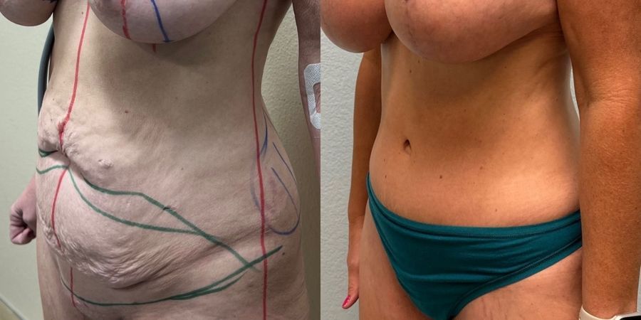 Tummy Tuck - Thumbnail 2