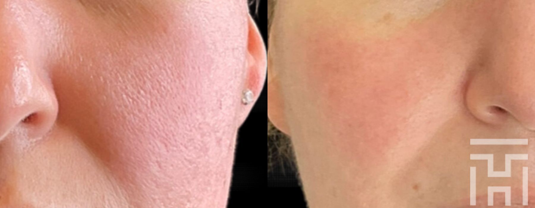 BBL® By Sciton - Case 8631