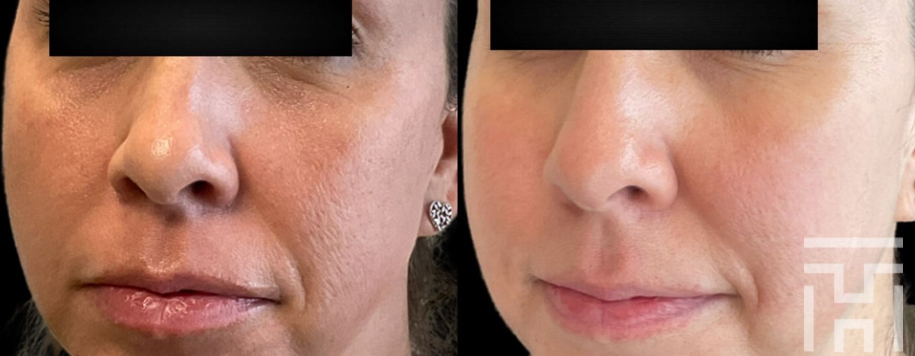 BBL® By Sciton - Case 8629