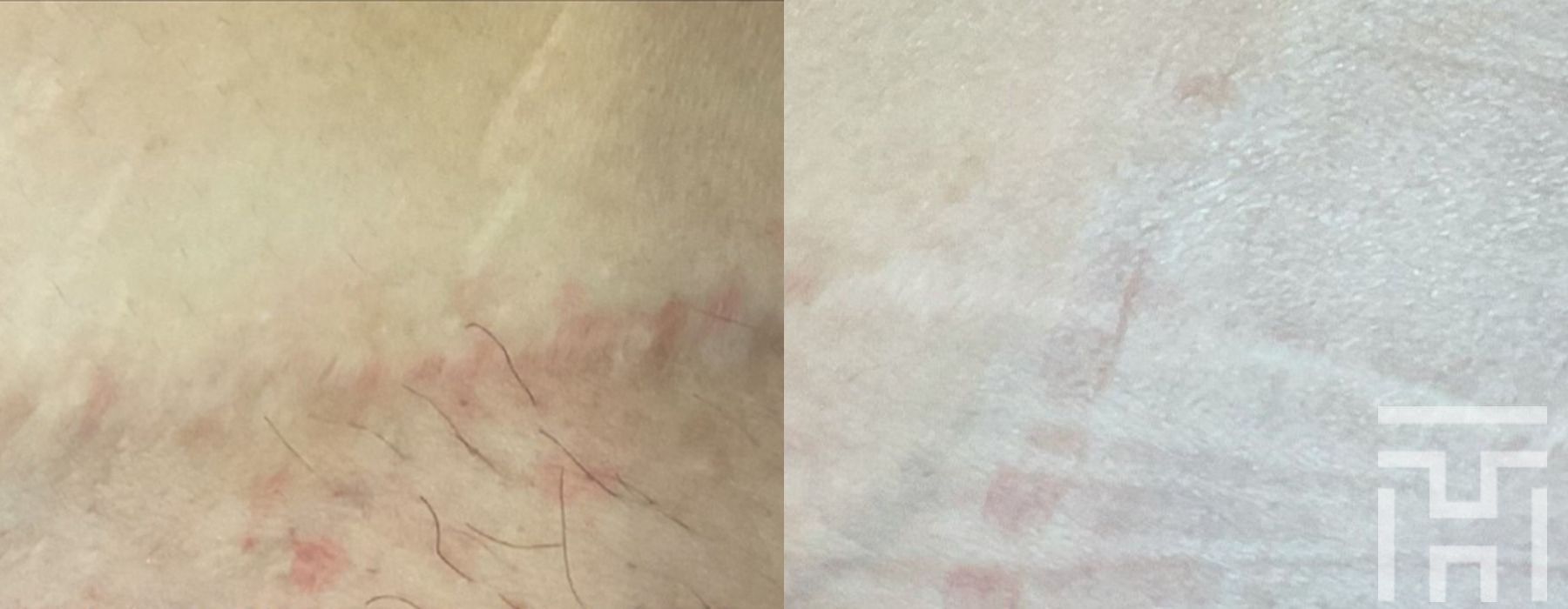 BBL® By Sciton - Case 8630