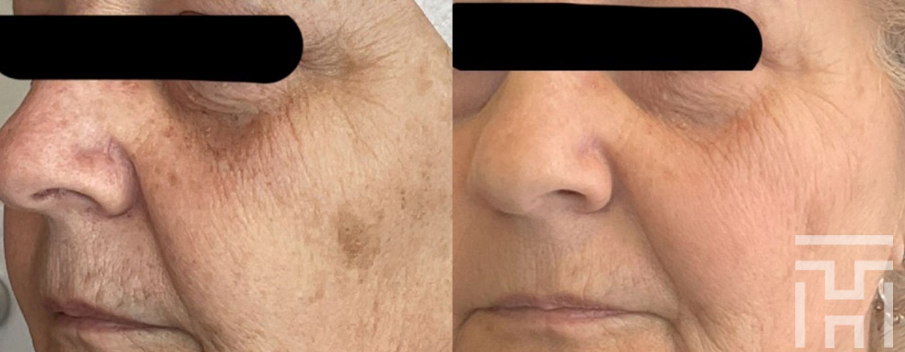 BBL® By Sciton - Case 8635