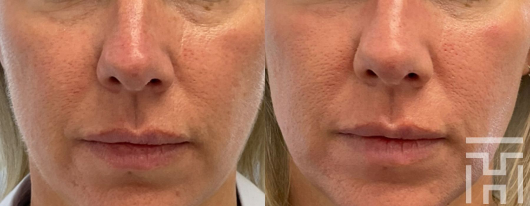 BBL® By Sciton - Case 8637