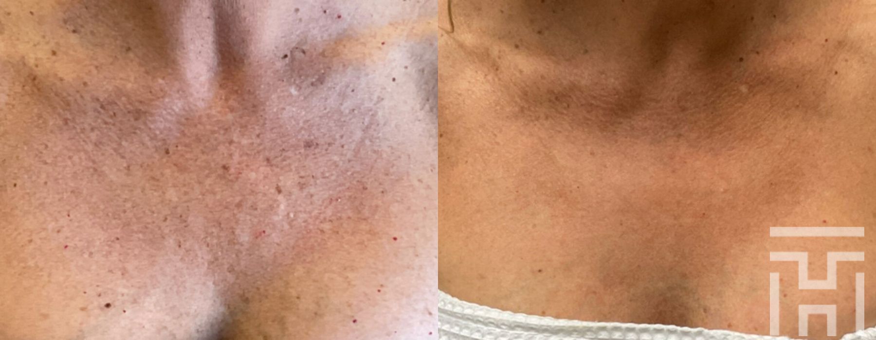 BBL® By Sciton - Case 8632